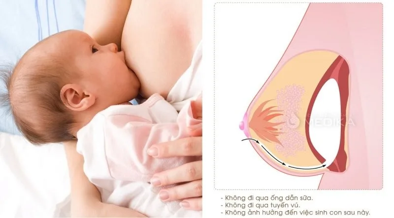 Giải đáp chi tiết: Nâng ngực có cho con bú được không?