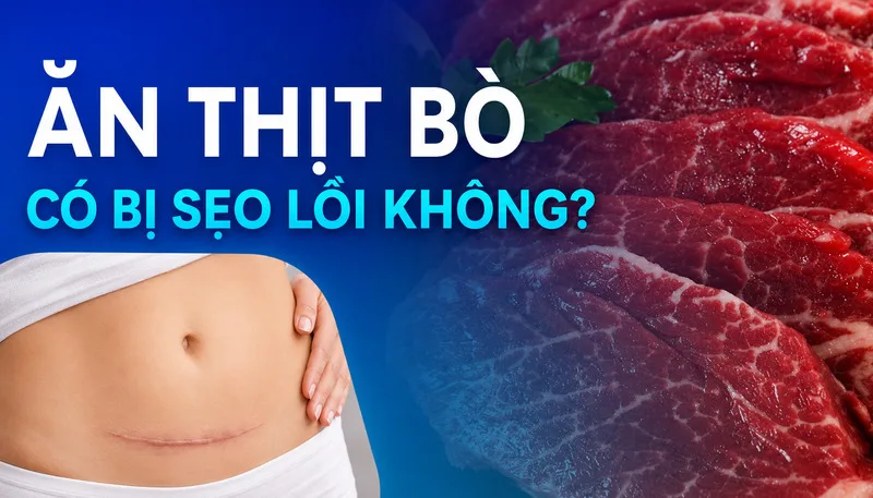 Ăn thịt bò sau sinh mổ chưa được xác định là nguyên nhân trực tiếp gây sẹo lồi; nguy cơ tạo sẹo còn phụ thuộc cơ địa, tiền sử và quá trình lành thương