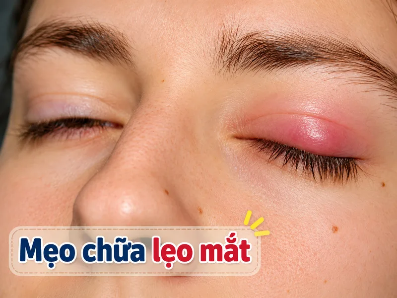 Những câu hỏi phổ biến giúp người bệnh hiểu rõ hơn về cách chăm sóc và xử lý lẹo mắt an toàn.
